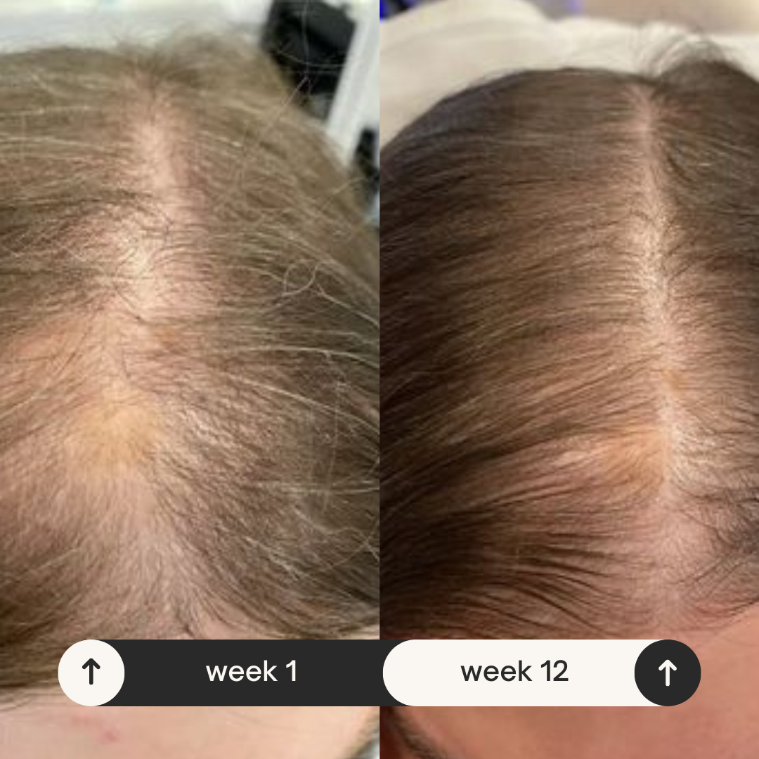 Buy Natural Hair Growth Serum for Hair Loss Treatment