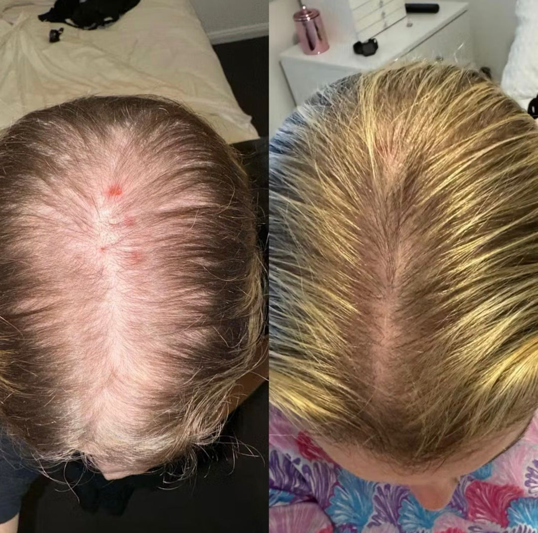 How to Treat Female Hair Loss: A Comprehensive Guide - Praela
